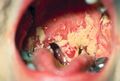 Oral thrush caused by Candida albicans