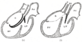 Illustration of the heart with truncus arteriosus