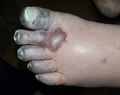 Left foot third degree frostbite