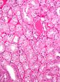 Chromophobe renal cell carcinoma