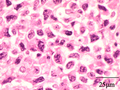Histopathology of extranodal NK-T cell lymphoma, nasal type