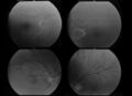 Choroid folds