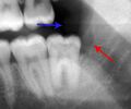 Pericoronitis x-ray