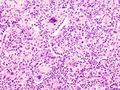 Aspiration pneumonia histology
