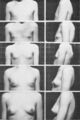 Female breasts five Tanner stages
