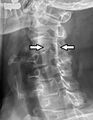 Cervical spinal nerve 4