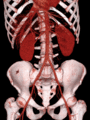 Volume rendered CT scan of abdominal and pelvic blood vessels (smaller)
