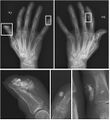 Calcinosis of CREST syndrome