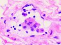 Invasive carcinoma of no special type