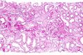 Renal biopsy