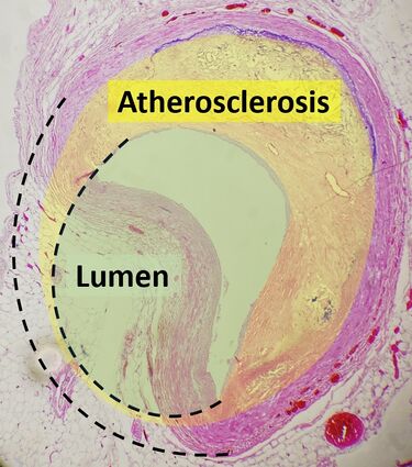 Histopathology of coronary artery atherosclerosis, annotated