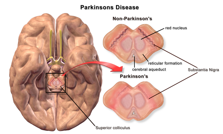 Parkinson's results from the death of dopamine-releasing neurons in the substantia nigra pars compacta