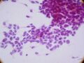 Desmoplastic small-round-cell tumor