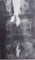 Myelography