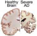 Brain affected by Alzheimer's disease