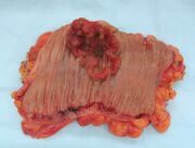 Colon cancer
