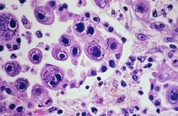 CMV-infected pneumocytes