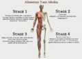 Alimentary Toxic Aleukia