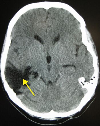 Brain Injury
