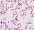 Warm autoimmune hemolytic anemia