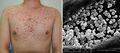 Pityrosporum folliculitis