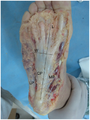 Plantar Aponeurosis - Axial View