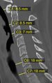 CT of prevertebral space