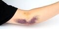 Plateletpheresis hematoma, 2016