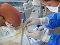 Lumbar puncture on a newborn