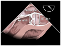 Transthoracic echocardiogram