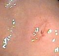 Gastric ulcer 2