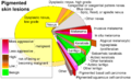 Pie chart of incidence and malignancy of pigmented skin lesions