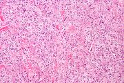 Micrograph of a solitary fibrous tumor
