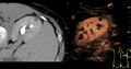 Contrast-enhanced ultrasonography of benign lesion