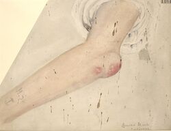 Gouty tophi on the elbow