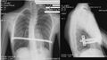X-ray after Nuss procedure
