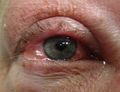 Allergic conjunctivitis