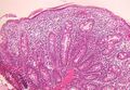 Tricho-hepato-enteric syndrome