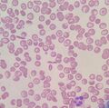 Blood film of Hemoglobin SC disease