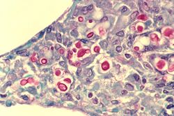 Cryptococcosis of lung in patient with AIDS
