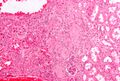 Renal Oncocytoma