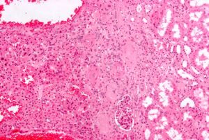 Renal oncocytoma