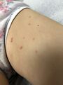 Molluscum contagiosum virus