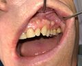Buccal exostosis