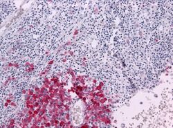 Malignant melanoma
