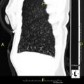 CT scan showing mucus impaction ("tree-in-bud")
