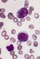 Two myeloblasts with Auer rods