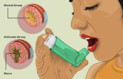 An Asthma patient taking medication using an inhaler