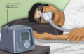Continuous positive airway pressure