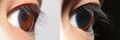 Iris (anatomy)